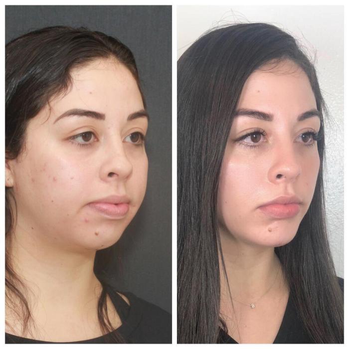 Before and after buccal exostosis removal