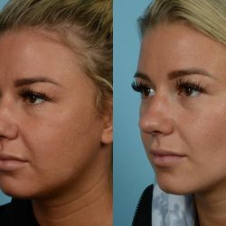 Before and after buccal exostosis removal