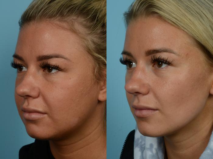 Before and after buccal exostosis removal