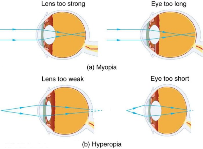 A person whose eye has a lens-to-retina distance of 2.0cm